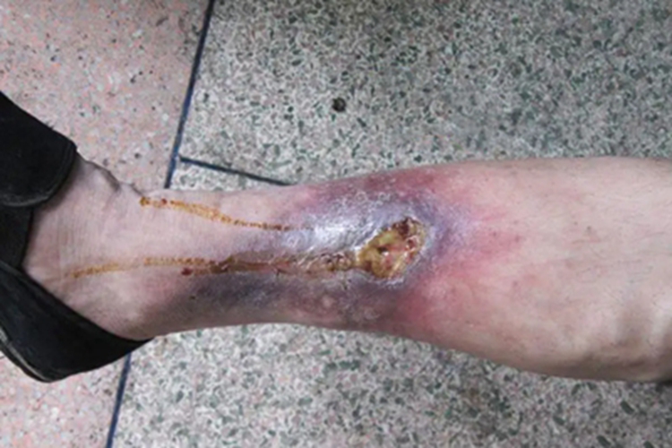 下肢静脉曲张症状图 下肢静脉曲张症状图