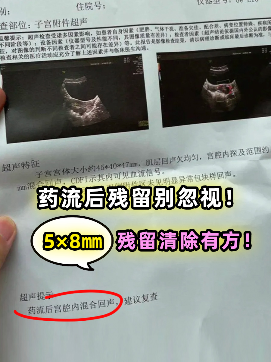 药流后残留别忽视!5×8㎜残留清除有方!