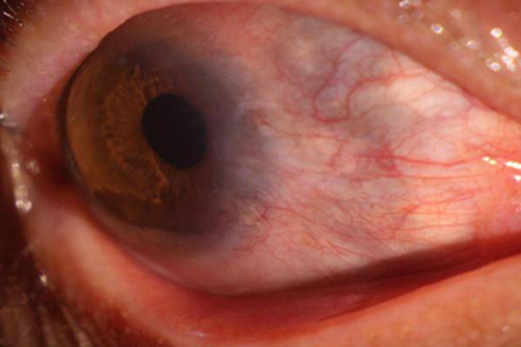 眼眶肿瘤出现血丝图