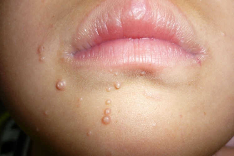 传染性软疣下巴症状图