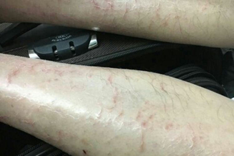 血管萎缩性皮肤异色病小腿红纹图 血管萎缩性皮肤异色病小腿红纹图