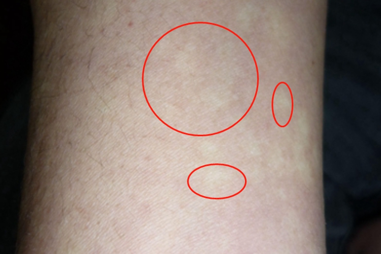 马歇尔-怀特综合征胳膊症状图 马歇尔-怀特综合征胳膊症状图