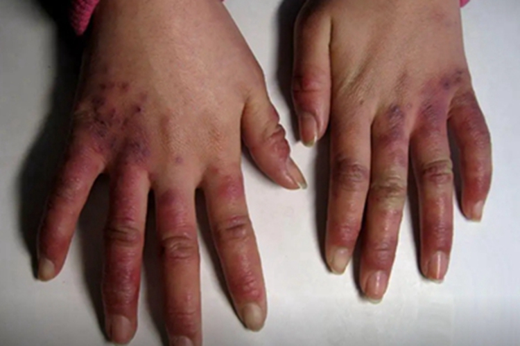 冻疮样红斑狼疮手指发红图