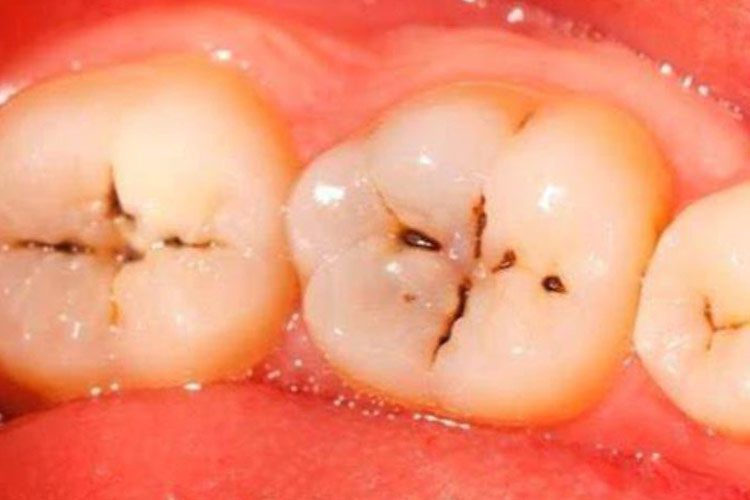 发生在牙冠为牙釉质龋,又分为窝沟龋和平滑面龋;发生在牙颈部或者牙根