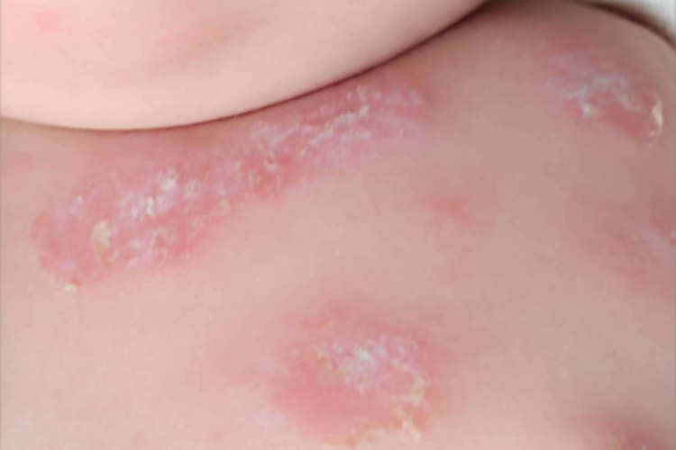 干燥型婴儿湿疹胸部脱皮图