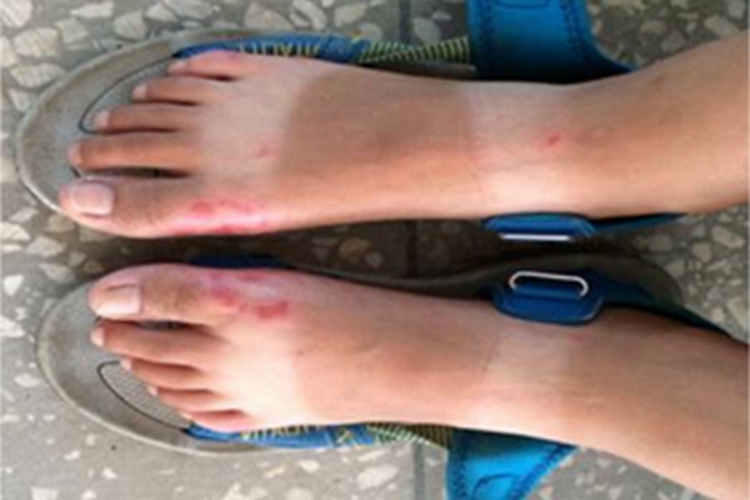 油漆皮炎脚背红斑图