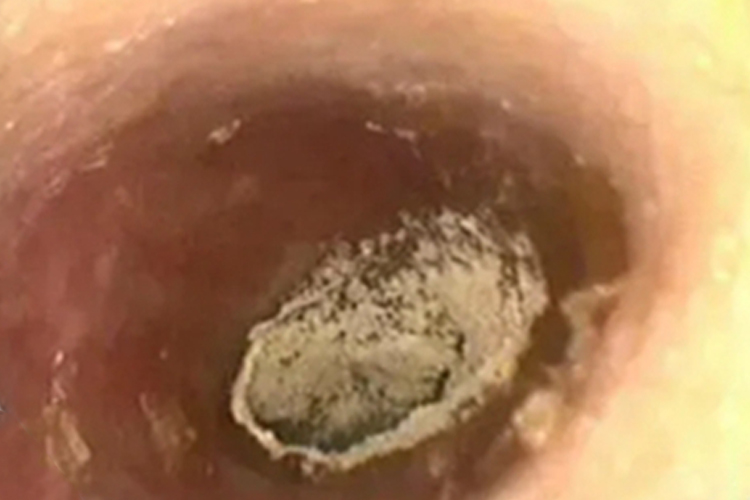 外耳道炎外耳道有白色脱屑图