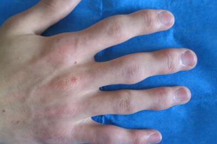 类风湿关节炎图