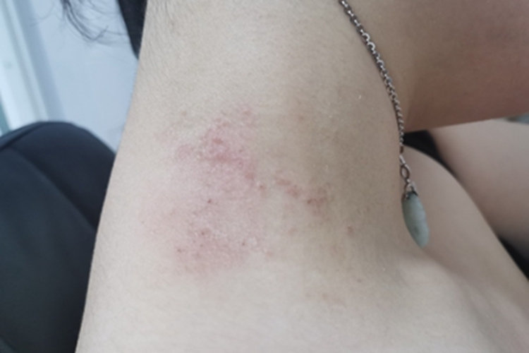 局限性神经性皮炎侧颈小红疙瘩图