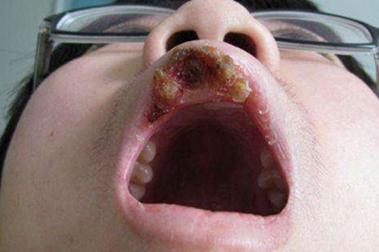 颌面部获得性梅毒嘴唇症状图 颌面部获得性梅毒嘴唇症状图