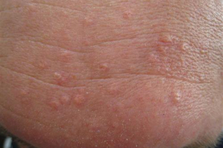 早熟性皮脂腺增生疙瘩图