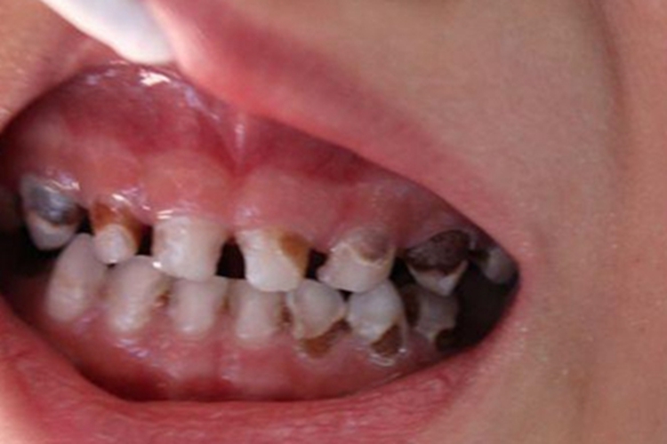 低龄儿童龋牙齿龋坏图 低龄儿童龋牙齿龋坏图