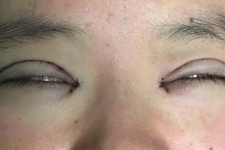 全切双眼皮眼睑闭合不全图 全切双眼皮眼睑闭合不全图