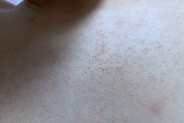 红痱胸前长一片小丘疹图