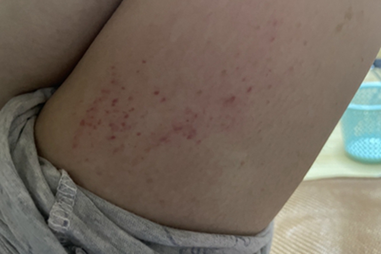 亚急性接触性皮炎大腿红点图