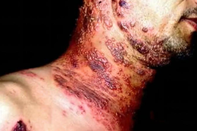 结节性梅毒疹颈部丘疹图