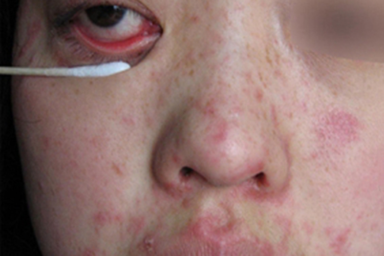 典型麻疹出疹期面部症状图 典型麻疹出疹期面部症状图