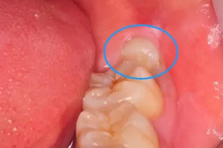 左下颌智齿部分萌出图