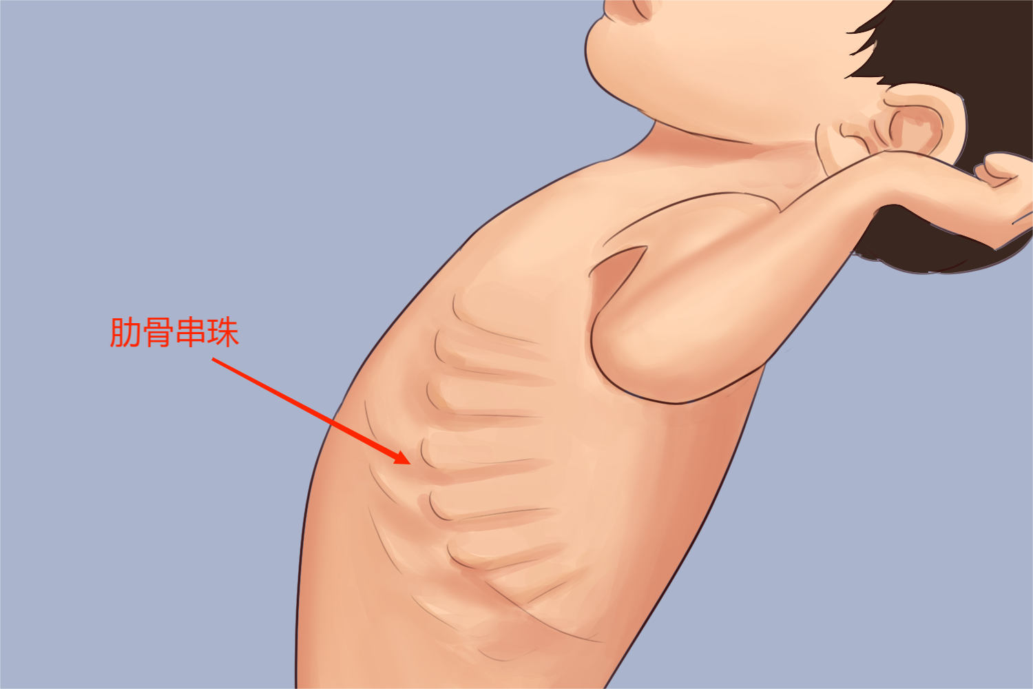 佝偻病肋骨串珠图