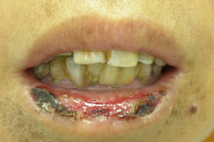 急性光化性唇炎嘴唇结痂图