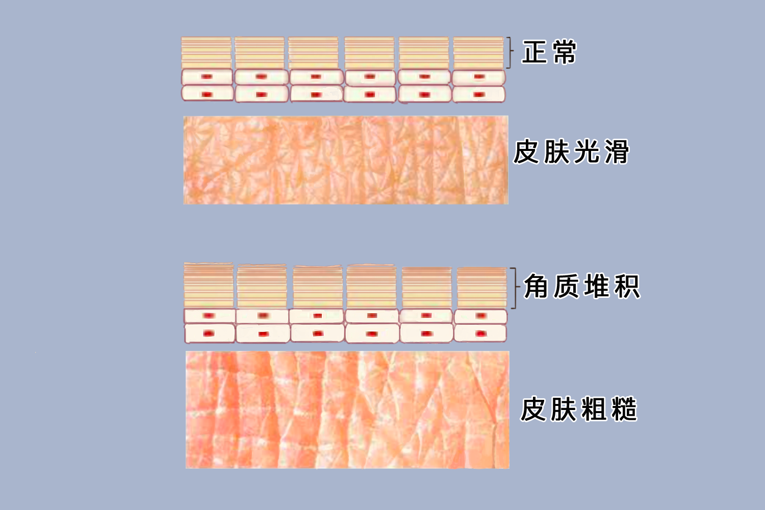 死皮和角质图片_有来医生