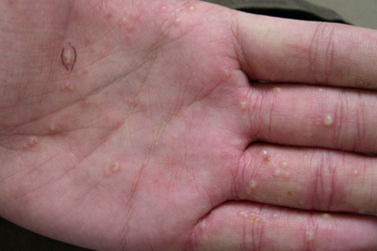 持久性脓疱性汗疱疹水疱图