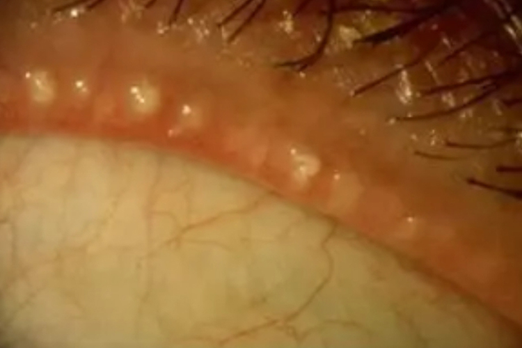 睑板腺口堵塞图 睑板腺口堵塞图