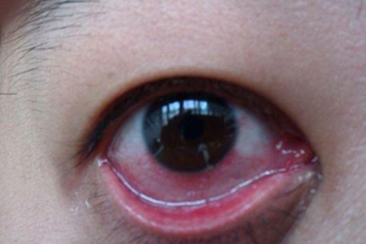 流行性出血性结膜炎充血图 流行性出血性结膜炎充血图