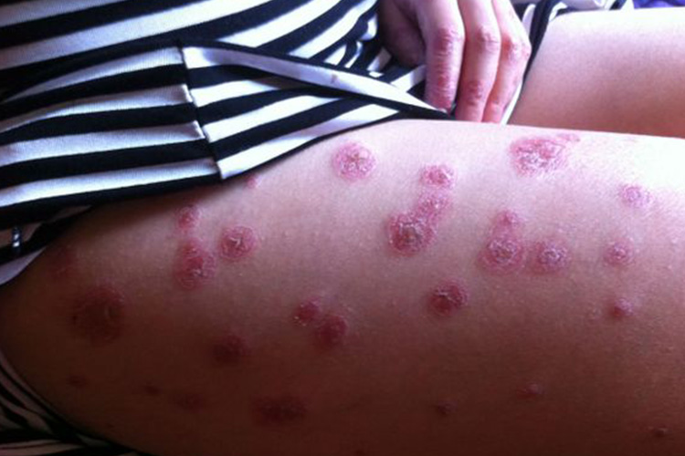 遗留色素沉着图 遗留色素沉着图