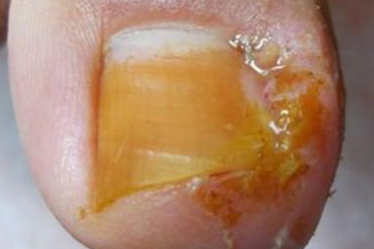 大脚趾急性甲沟炎图