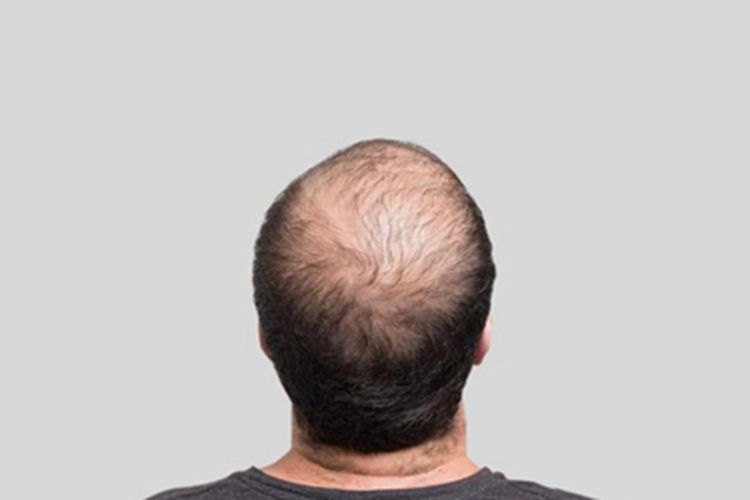 雄激素性脱发头顶一片秃了图
