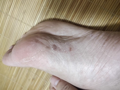 水疱型足癣脚底结痂图.jpg