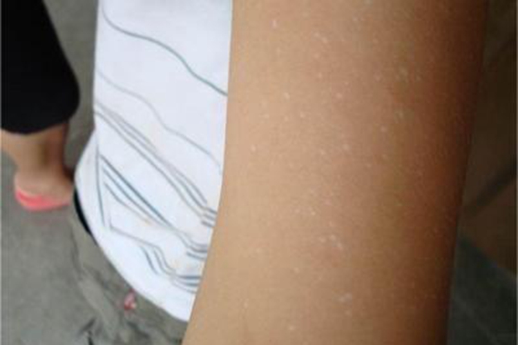 特发性滴状色素减少症胳膊白斑图 特发性滴状色素减少症胳膊白斑图