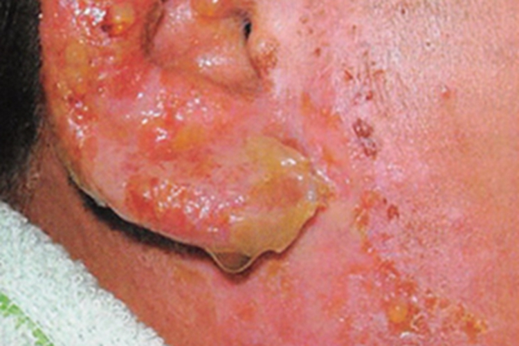 急性湿疹耳周糜烂图