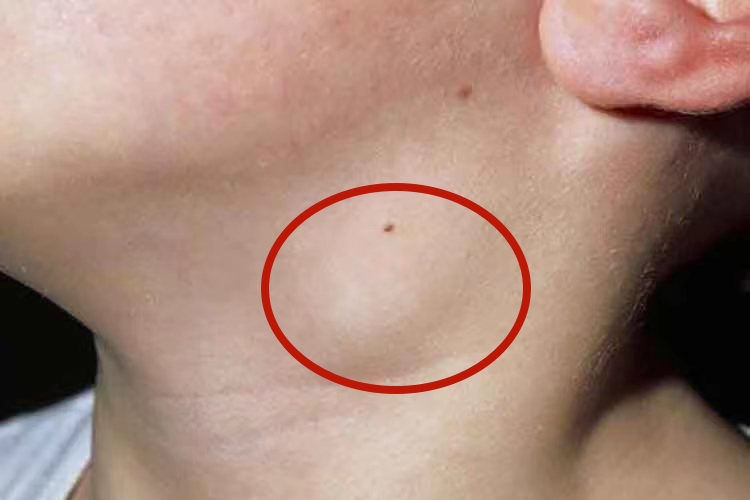 喉癌颈部包块图