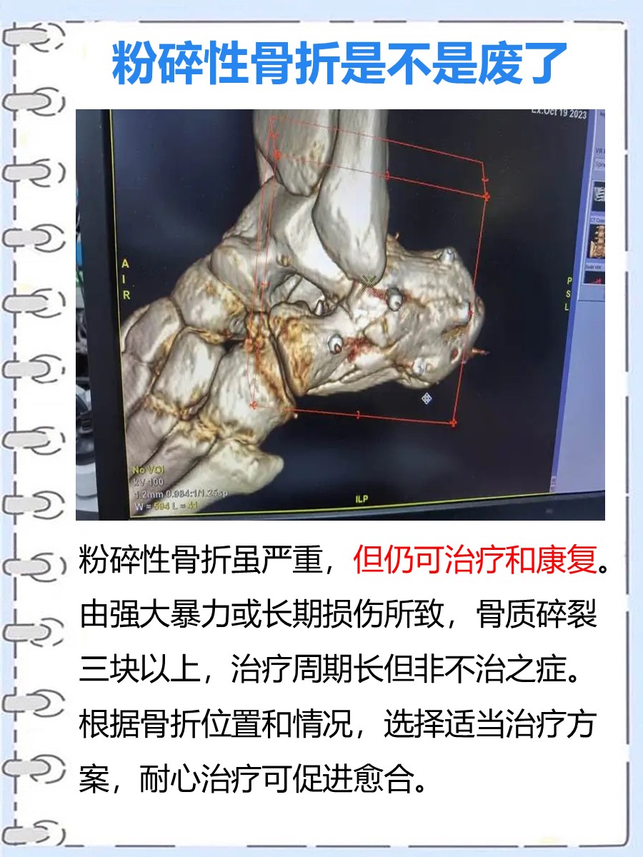 粉碎性骨折是不是废了 ，专家解答