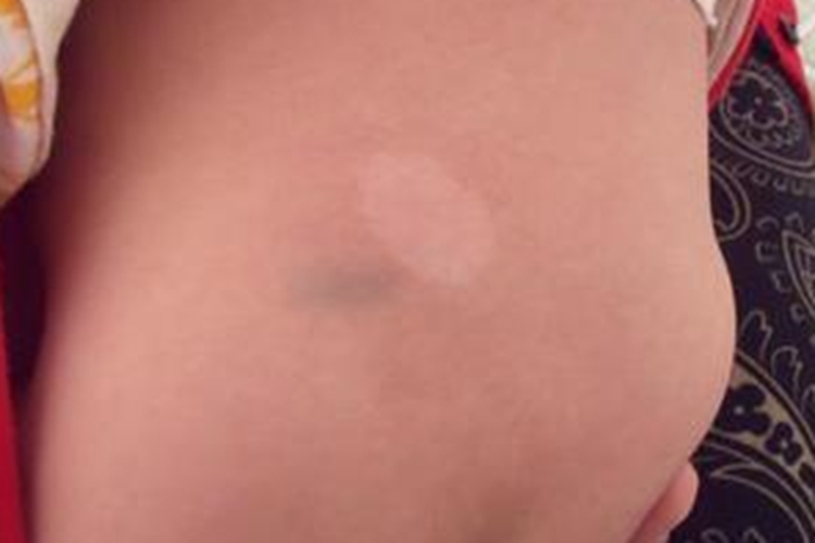 宝宝背部单纯糠疹图