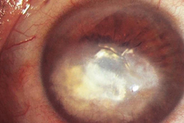 结核性角膜基质炎角膜斑图
