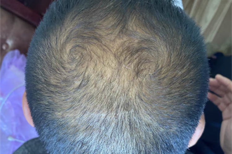 雄激素性脱发头上头发变少图 雄激素性脱发头上头发变少图