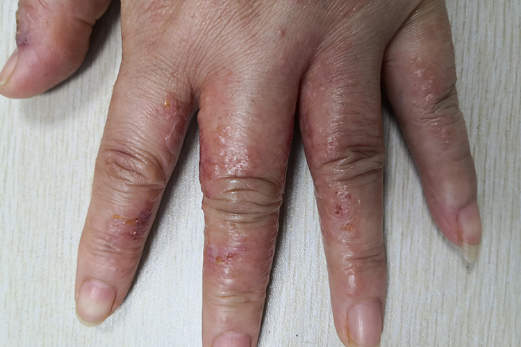急性湿疹图