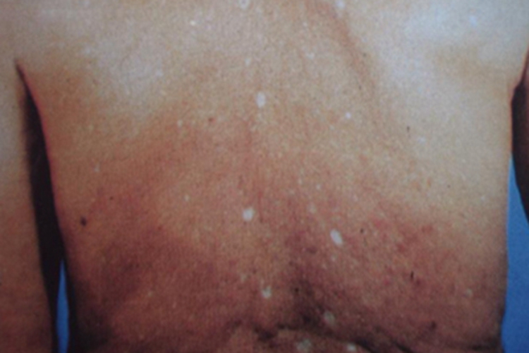 特发性滴状色素减少症症状图