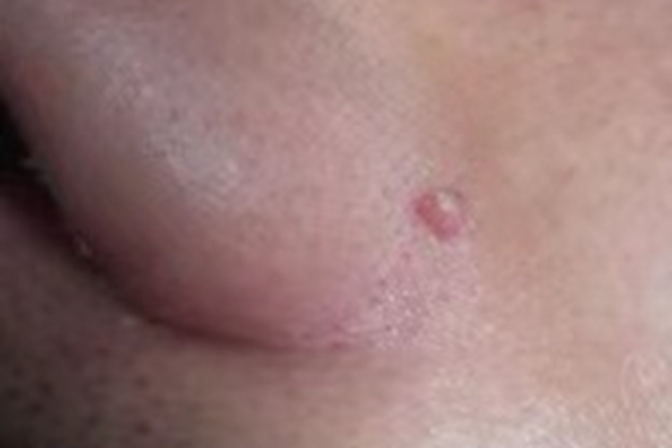 鼻翼纤维瘤图 鼻翼纤维瘤图