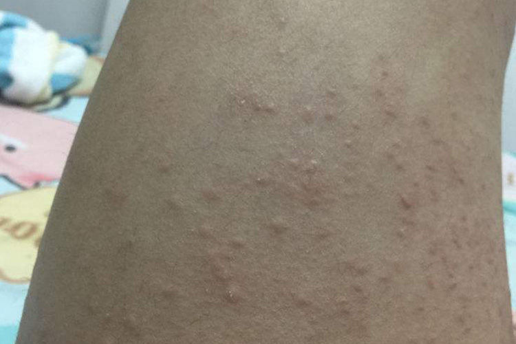 鸡皮疙瘩样皮损图