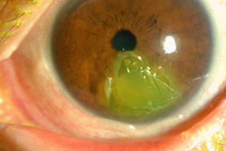 角膜挫伤角膜水肿图 角膜挫伤角膜水肿图