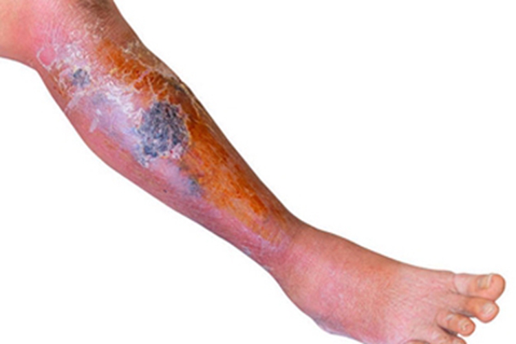 急性淋巴管炎小腿红肿图