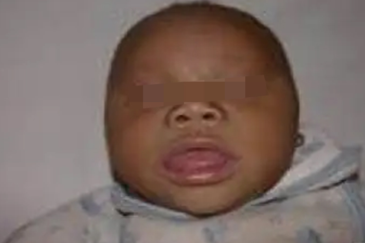 先天性甲状腺功能减退症婴儿伸舌头图