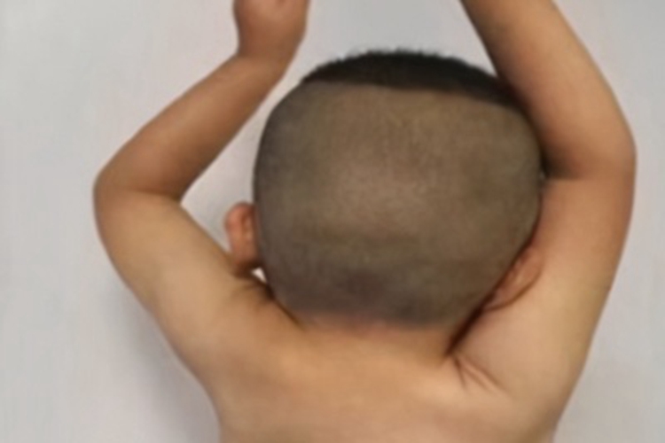 先天性高肩胛症发育不良图 先天性高肩胛症发育不良图