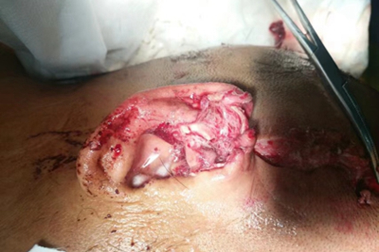 外伤耳廓缺损图 外伤耳廓缺损图