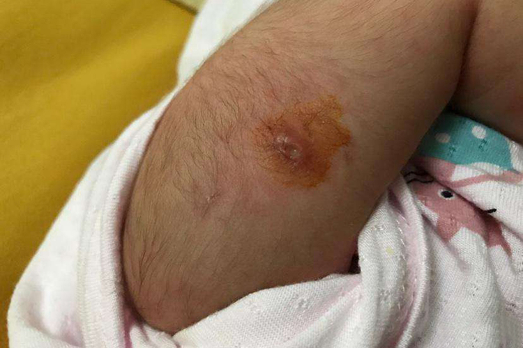 卡介苗接种后破溃图