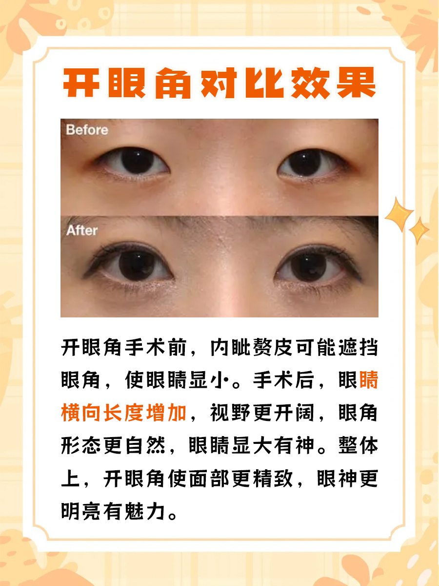 开眼角对比效果图